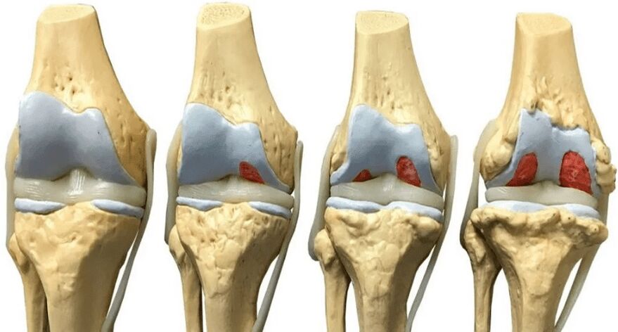 OstyHealth prevents the destruction of cartilage