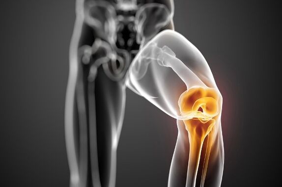 Knee arthrosis