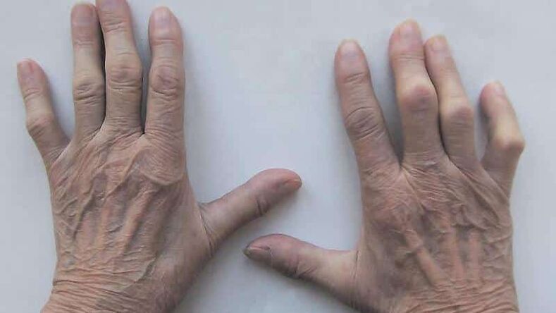 Methods of treating joint pain on the fingers