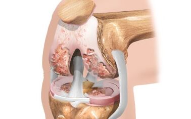 Knee arthrosis