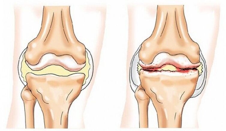 Healthy becomes the joint affected by arthrosis
