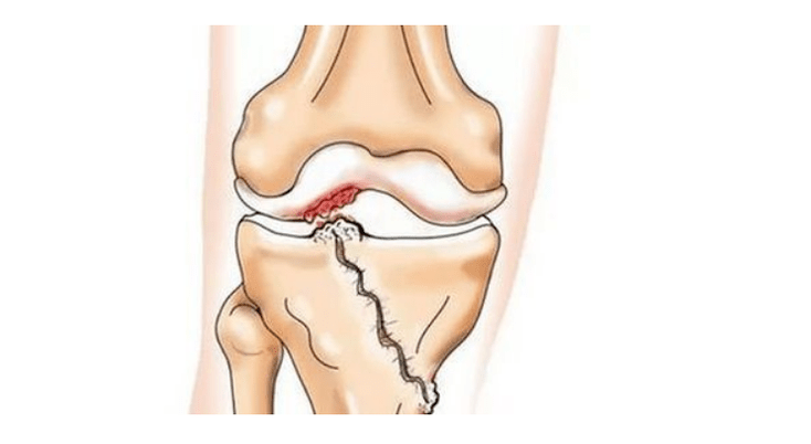 a crack in the knee joint